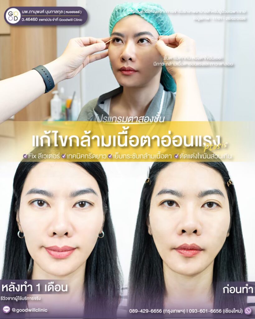 แก้ไขกล้ามเนื้อตา แก้ตาไม่เท่ากัน2