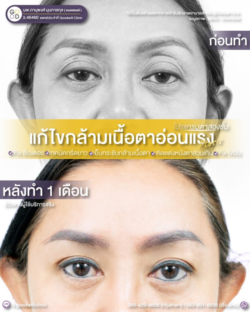 แก้กล้ามเนื้อตา แก้ยกคิ้ว