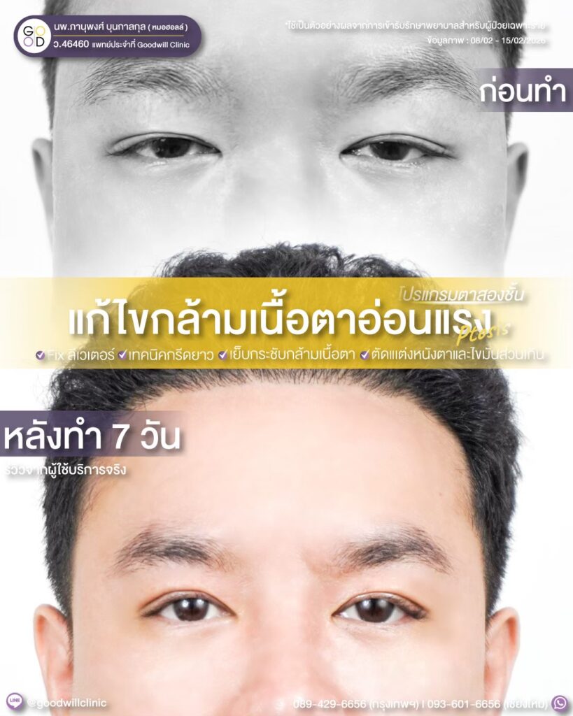 แก้กล้ามเนื้อตา แก้ยกคิ้ว 2
