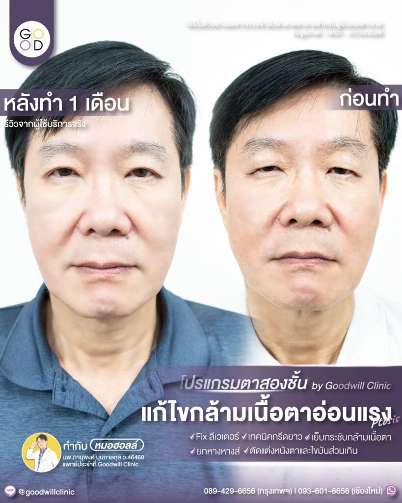 แก้กล้ามเนื้อตา แก้ยกคิ้ว 3