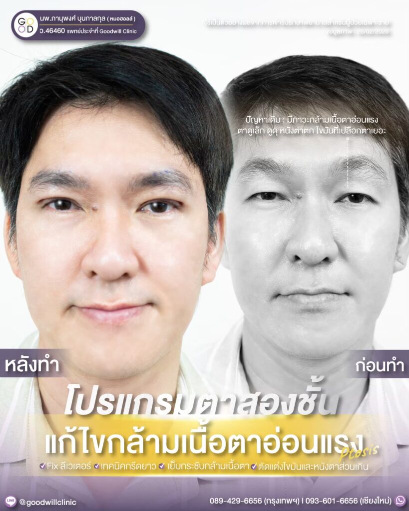 แก้กล้ามเนื้อตา แก้ยกคิ้ว 1