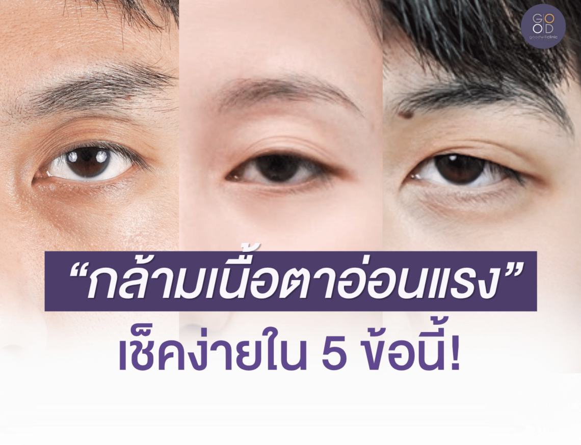 กล้ามเนื้อตาอ่อนแรง สังเกตยังไง ปก