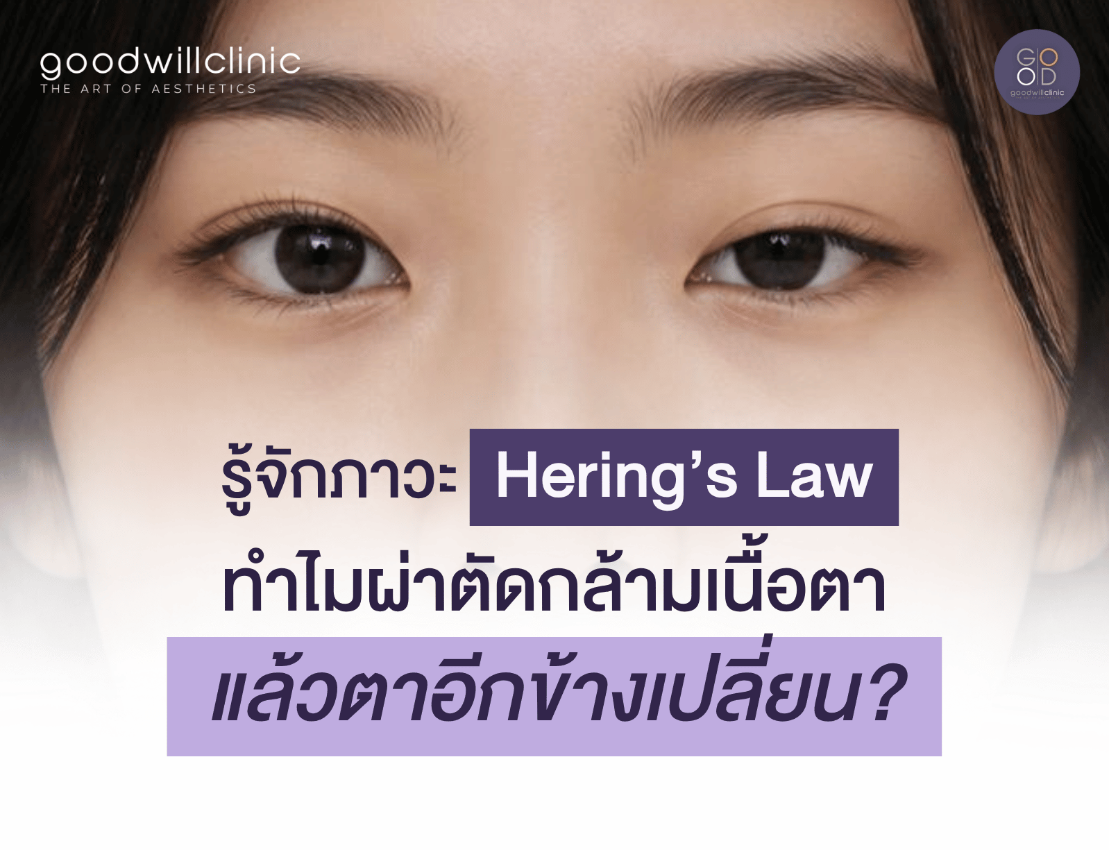 ทำไมผ่าตัดกล้ามเนื้อตาอ่อนแรงแล้ว อีกข้างถึงเปลี่ยน เข้าใจ Hering's Law ด้วยตัวอย่างไม้กระดก ปก