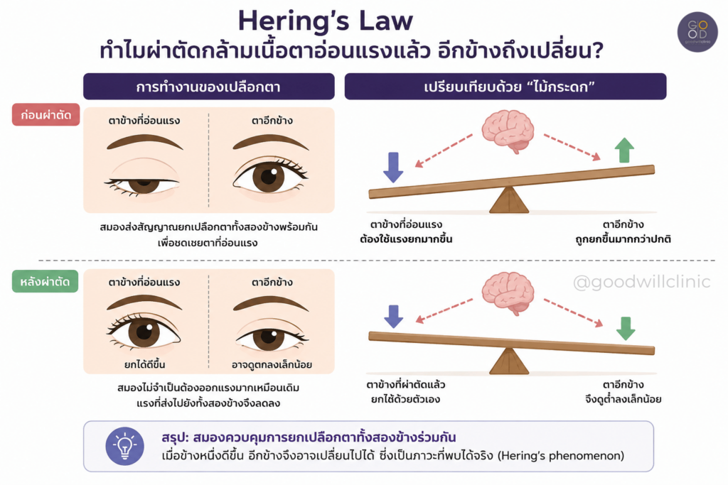 ภาวะ Hering ตาสองข้างเปิดไม่เท่ากันหลังแก้กล้ามเนื้อตาอ่อนแรง