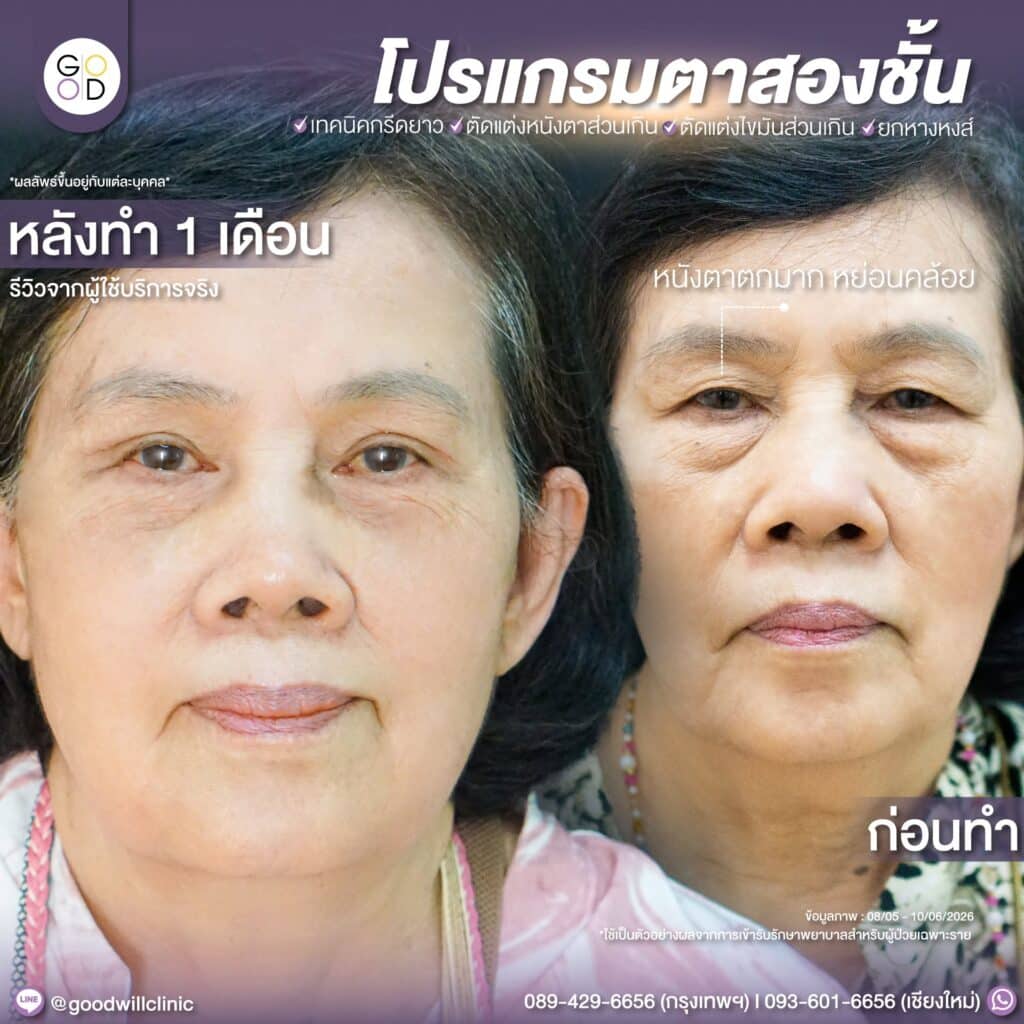 รีวิวทำตาสองชั้น+ตัดถุงใต้ตา ผู้สูงอายุ 1