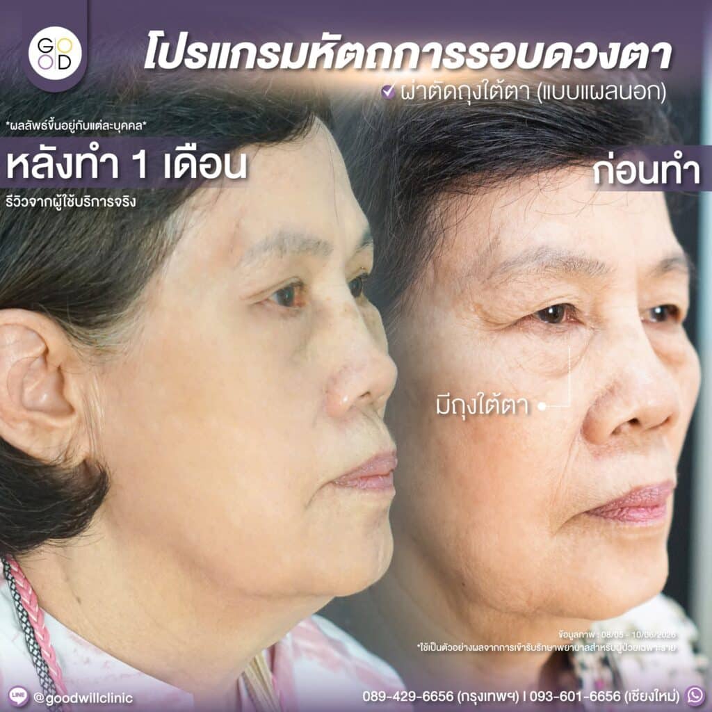 รีวิวทำตาสองชั้น+ตัดถุงใต้ตา ผู้สูงอายุ 3