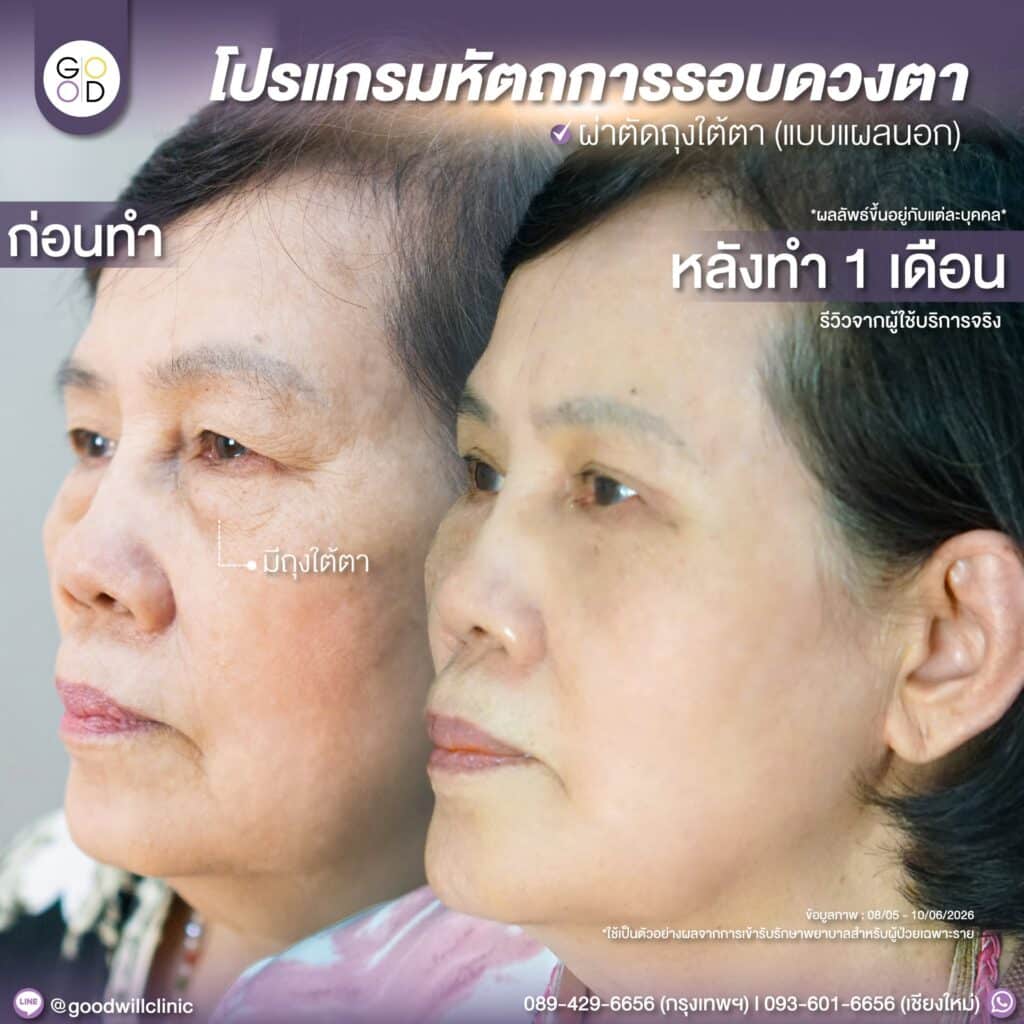 รีวิวทำตาสองชั้น+ตัดถุงใต้ตา ผู้สูงอายุ 2