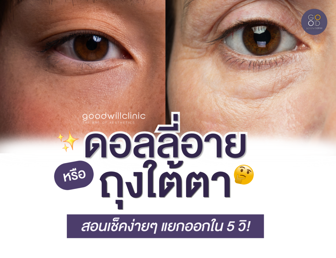 Dolly Eyes vs ถุงใต้ตา ต่างกันตรงไหน ส่องวิธีแยกให้ออกใน 5 วินาที! ปก