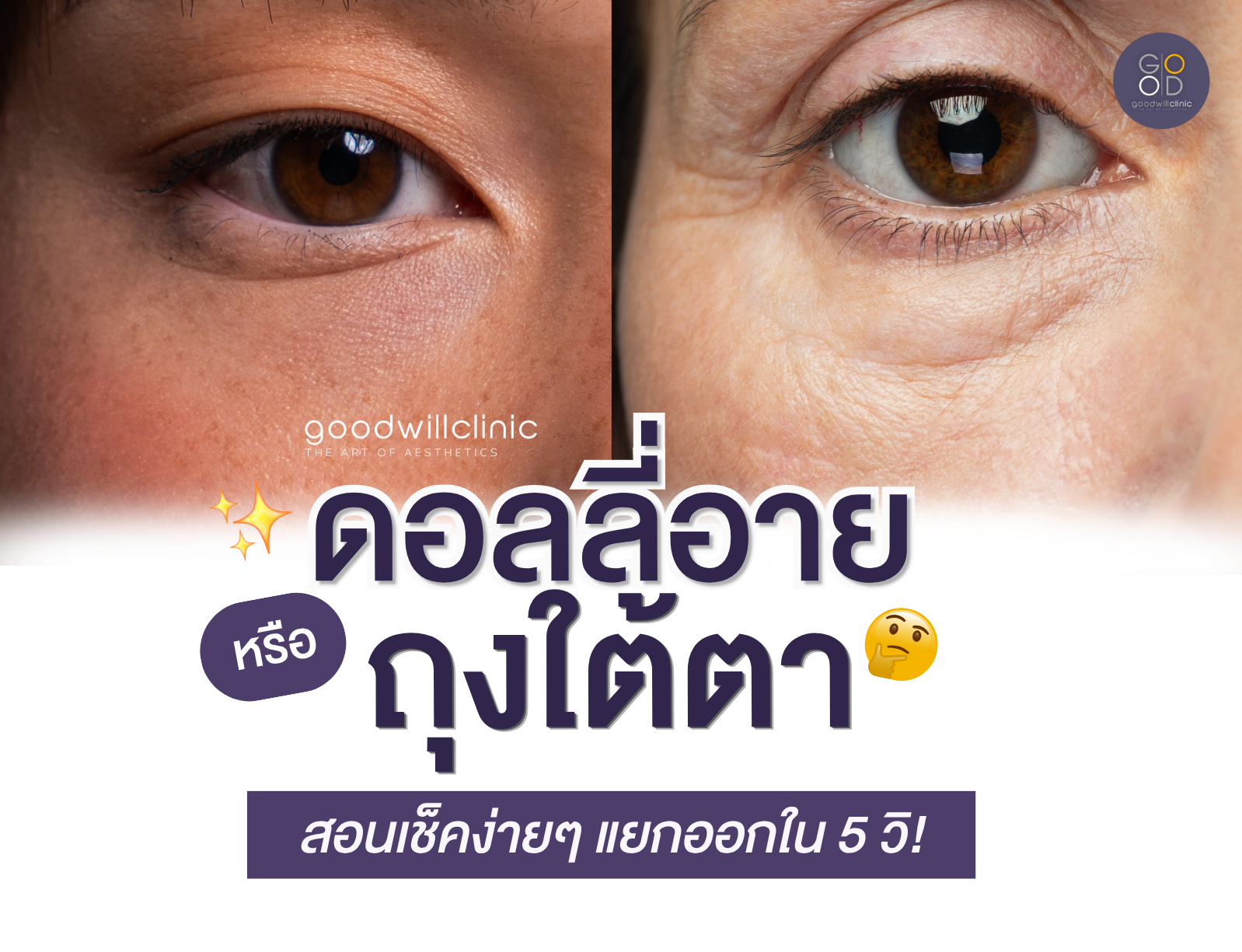 Dolly Eyes vs ถุงใต้ตา ต่างกันตรงไหน ส่องวิธีแยกให้ออกใน 5 วินาที! ปก