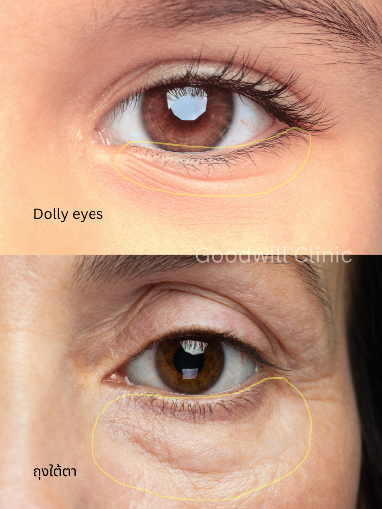 Dolly eyes vs ถุงใต้ตา