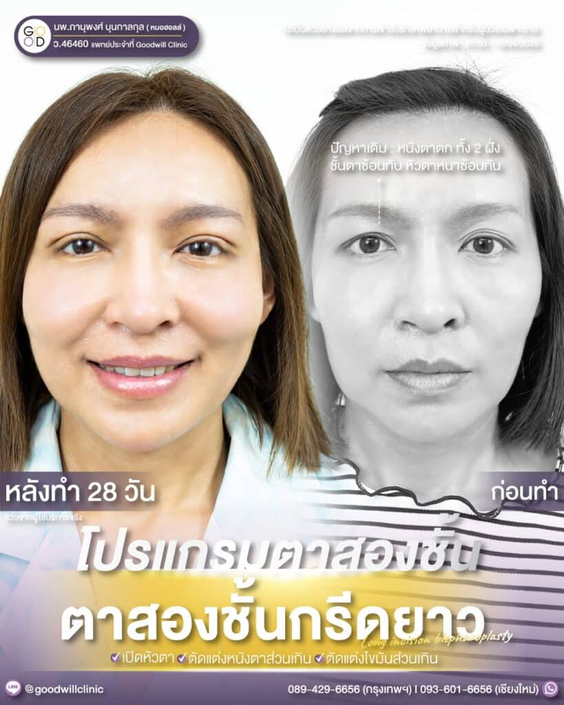 ชั้นตาหลายชั้น 2