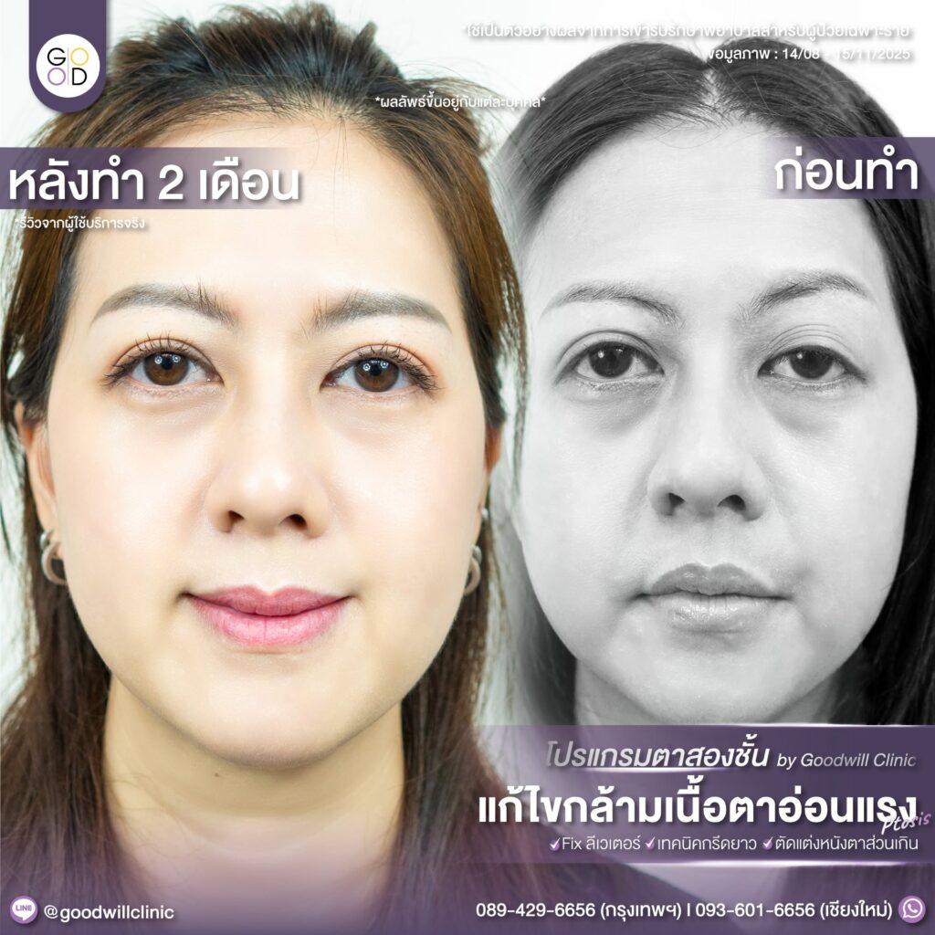 ชั้นตาหลายชั้น จากกล้ามเนื้อตา 1