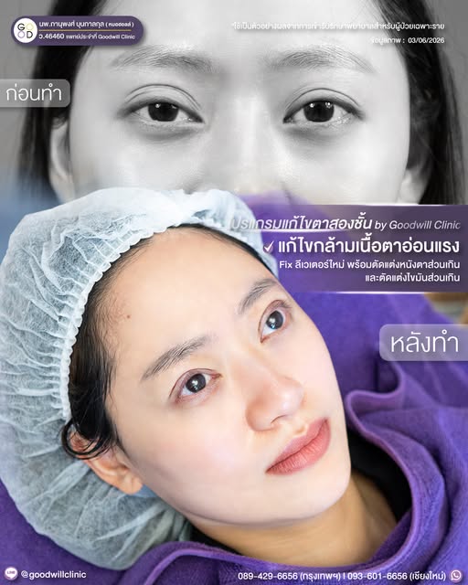 ชั้นตาหลายชั้น จากกล้ามเนื้อตา 3