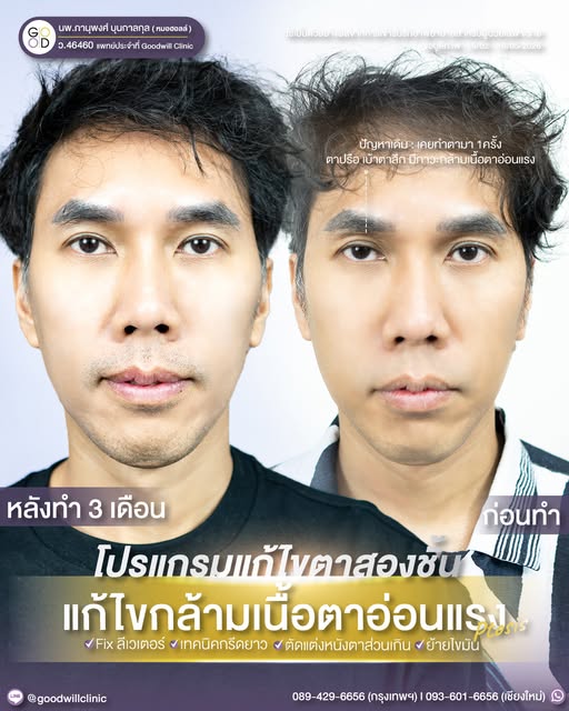 ชั้นตาไม่เท่ากัน 1