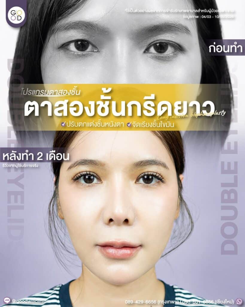 ชั้นตาไม่เท่ากัน 2