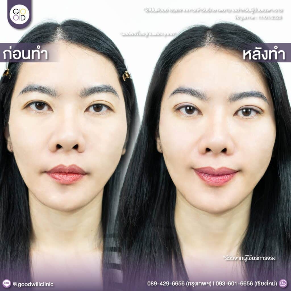 ชั้นตาไม่เท่ากัน 3
