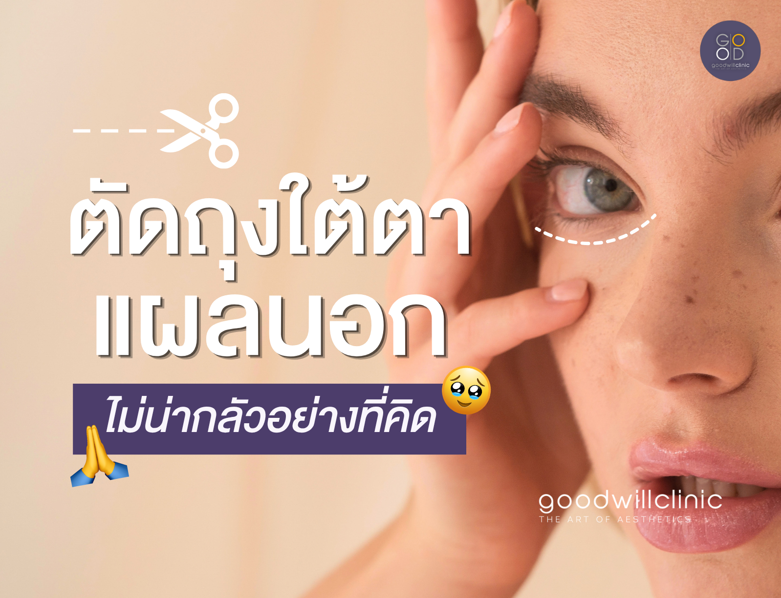 ตัดถุงใต้ตาแผลนอก ไม่น่ากลัวอย่างที่คิด ปก