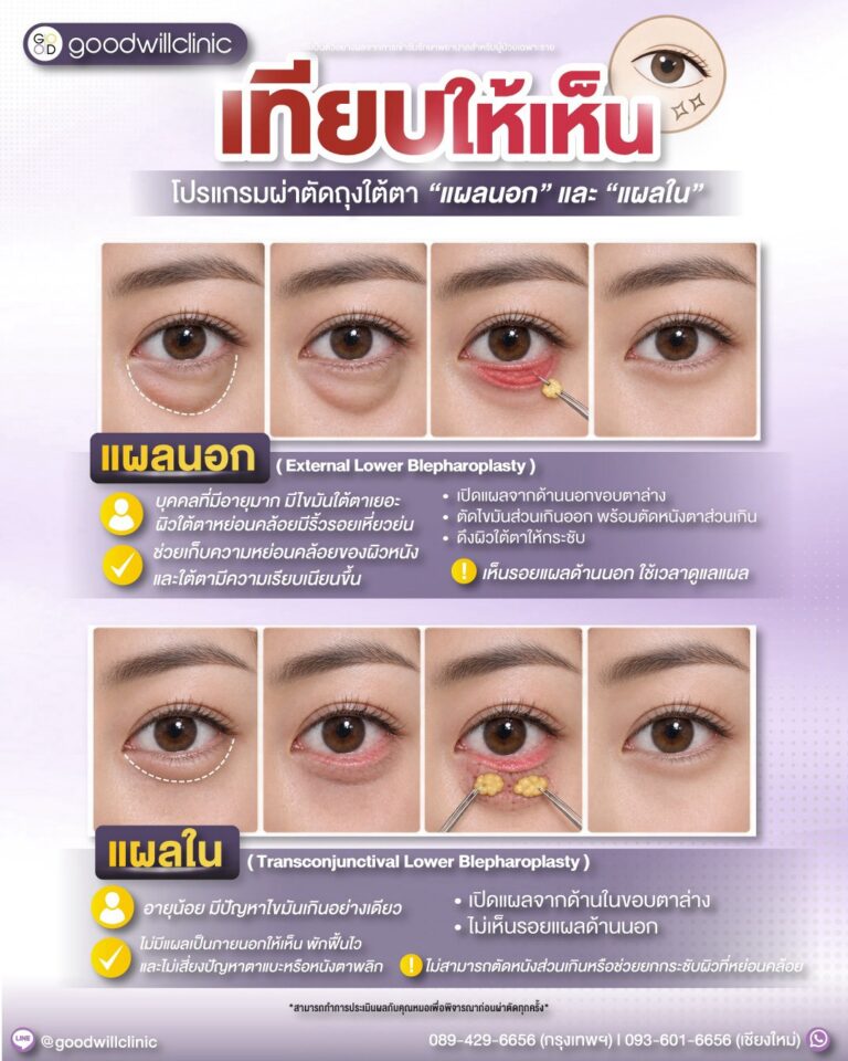 ผ่าตัดถุงใต้ตา แผลใน vs แผลนอก ต่างกันยังไง