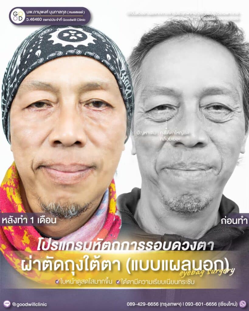 ผ่าตัดถุงใต้ตาแผลนอก 2