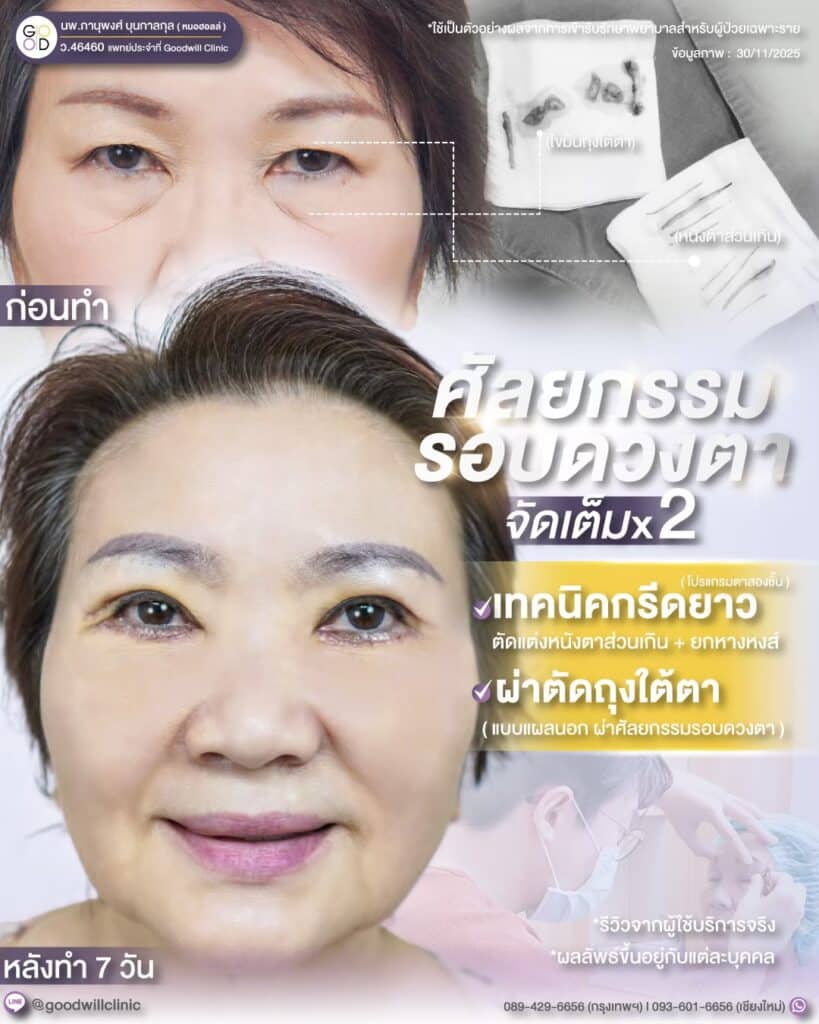 ผ่าตัดถุงใต้ตาแผลนอก 3