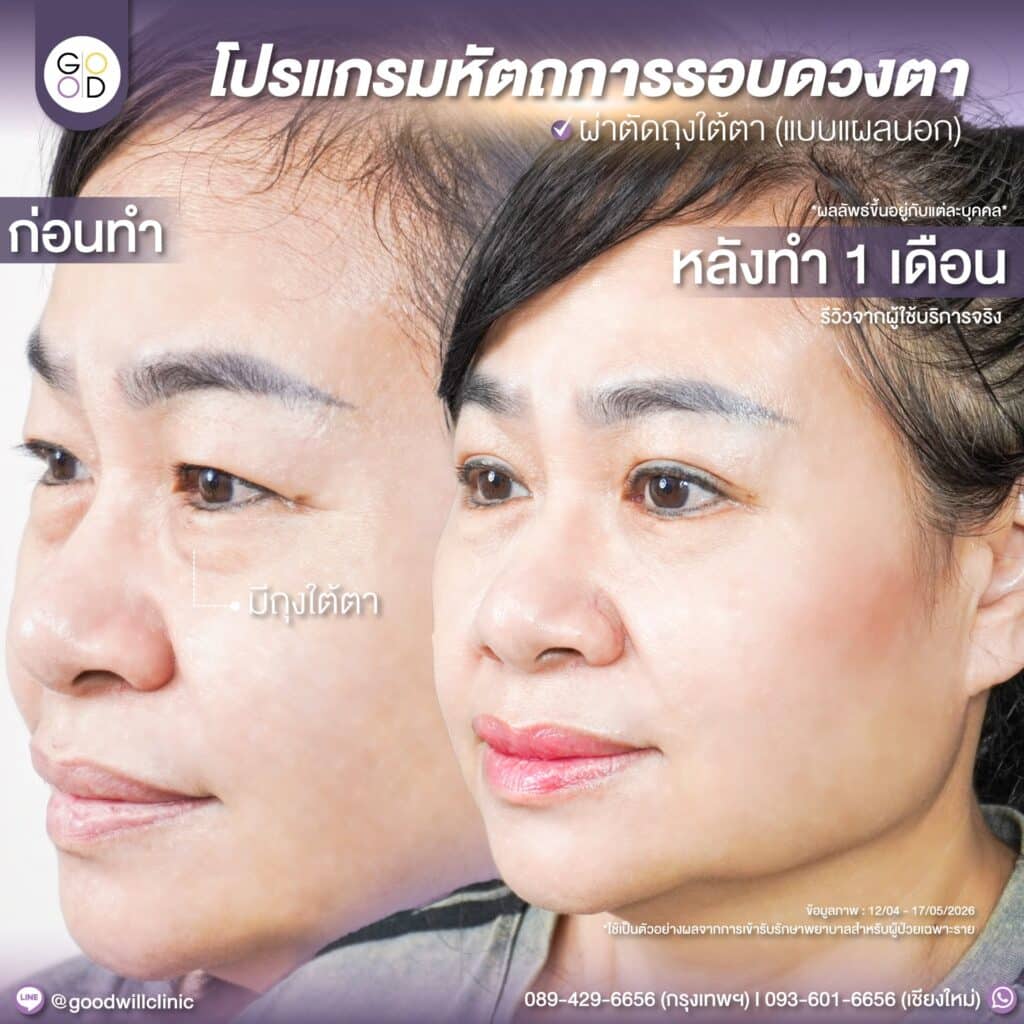 รีวิวตัดถุงใต้ตา goodwill แผลนอก 1