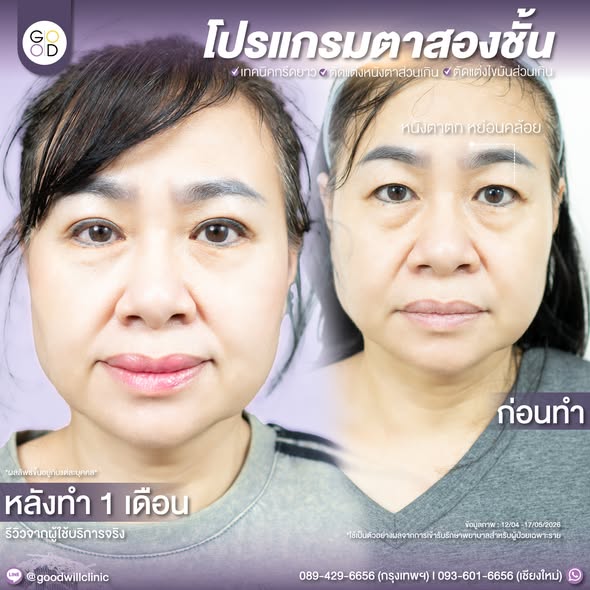รีวิวตัดถุงใต้ตา goodwill แผลนอก 2