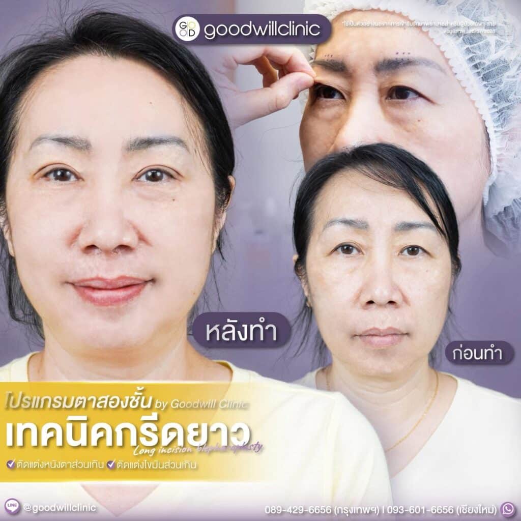 หนังตาก 3