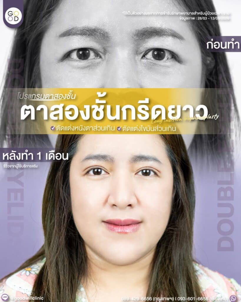 หนังตาตก 1