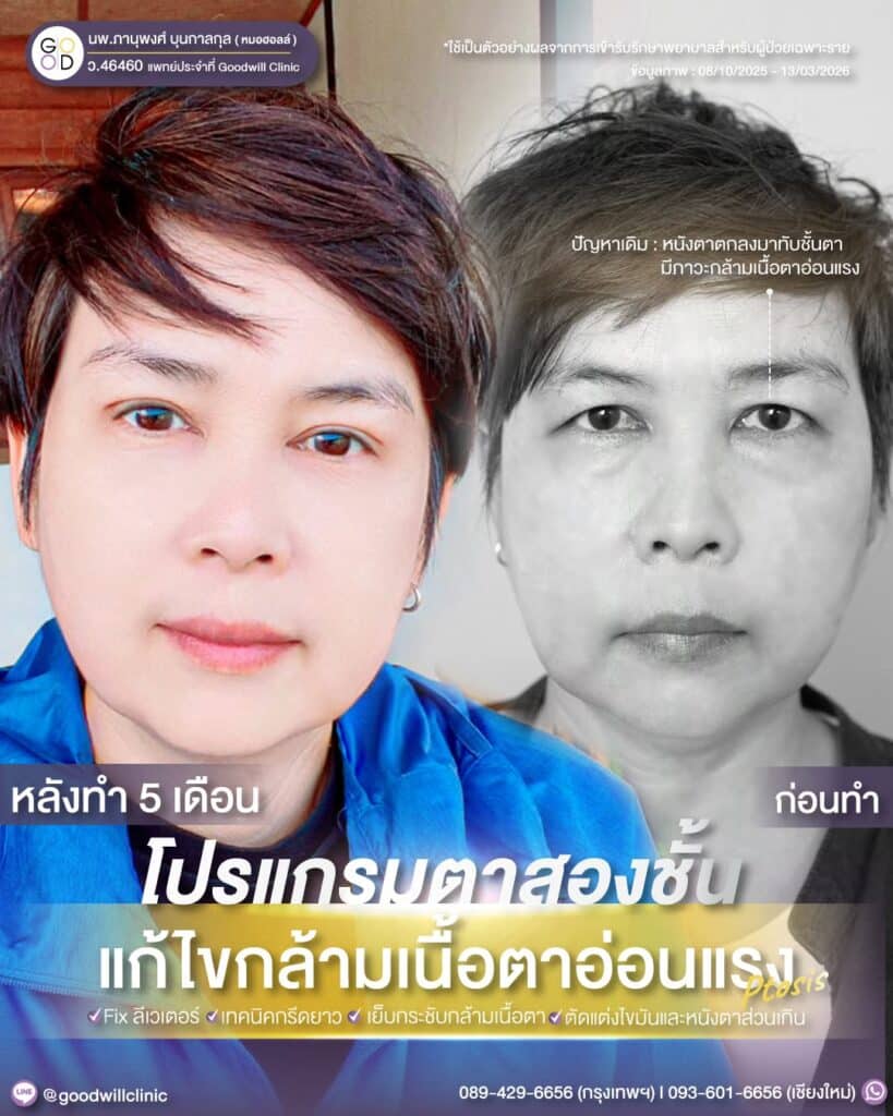หนังตาตก 2