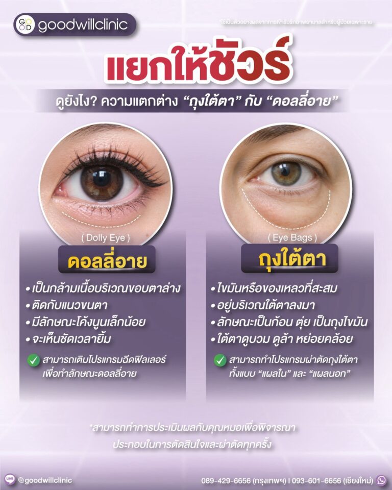 เช็คให้ชัวร์ dolly eyes vs ถุงใต้ตา
