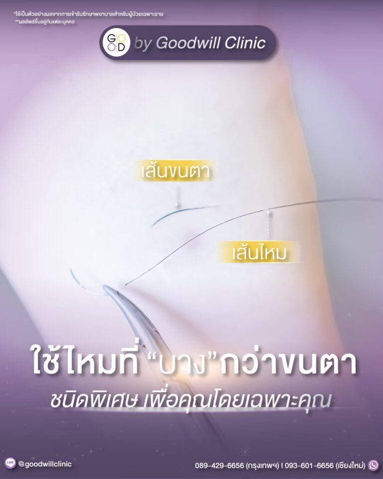 ไหมใช้เย็บถุงใต้ตาแผลนอก