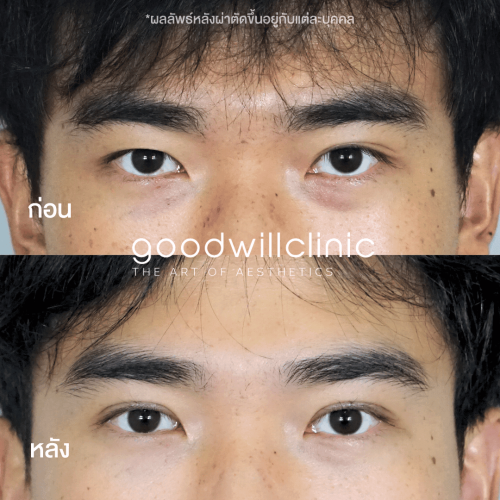 รีวิวตาสองชั้นผู้ชาย 1