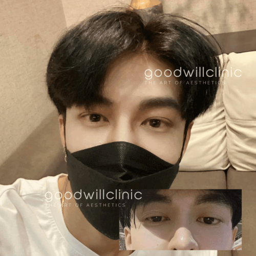 รีวิวตาสองชั้นผู้ชาย 9