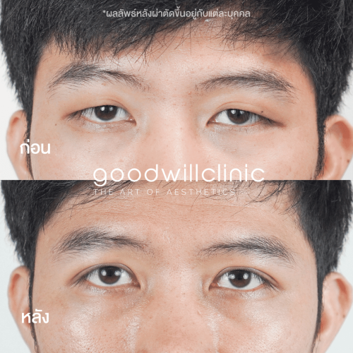รีวิวตาสองชั้นผู้ชาย