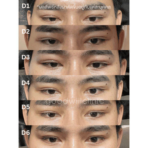 อาการหลังทำตาสองชั้น ที่สามารถหายได้เอง ไม่ต้องพบหมอ 1