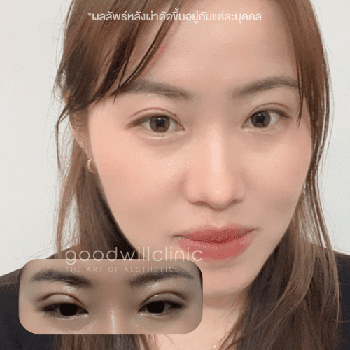 ทำตาสองชั้น อายุ 30 ทำได้ไหม