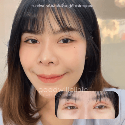 อาการหลังทำตาสองชั้น ที่สามารถหายได้เอง ไม่ต้องพบหมอ 5